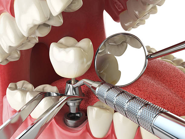 Best Emergency Dentist for Knocked-Out Tooth in Monona, IA